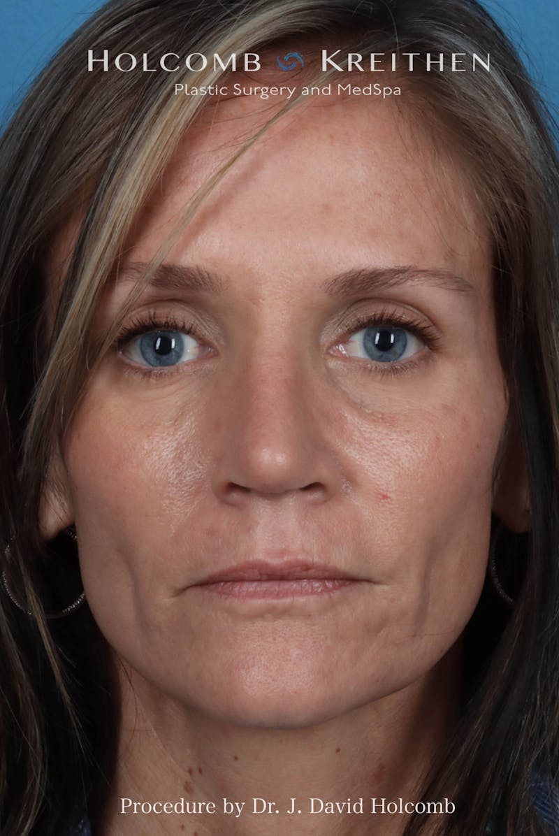 Rhinoplasty Before & After Gallery - Patient 104927 - Image 4