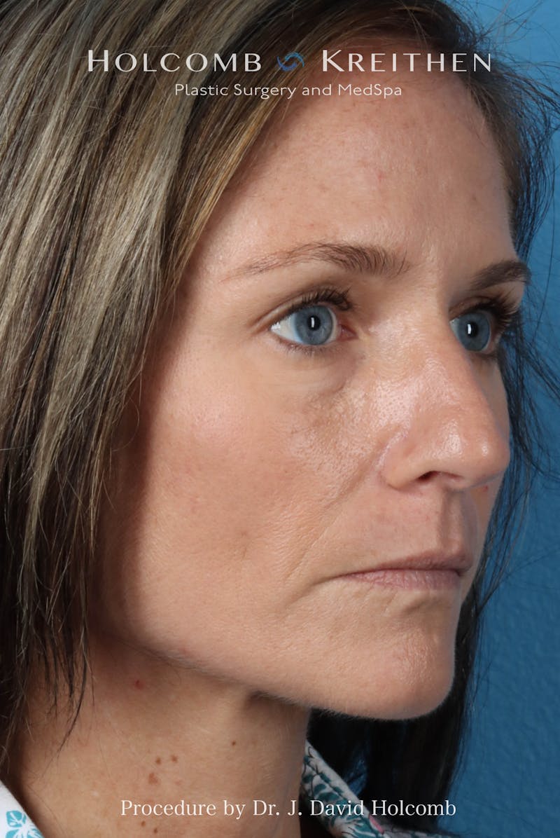 Rhinoplasty Before & After Gallery - Patient 104927 - Image 5