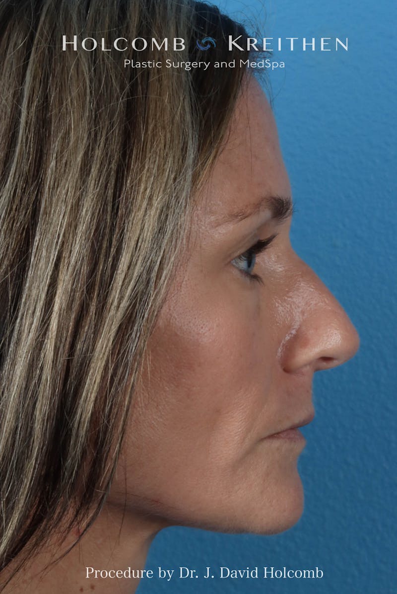Rhinoplasty Before & After Gallery - Patient 104927 - Image 9