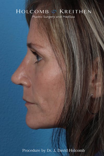 Rhinoplasty Before & After Gallery - Patient 104927 - Image 2