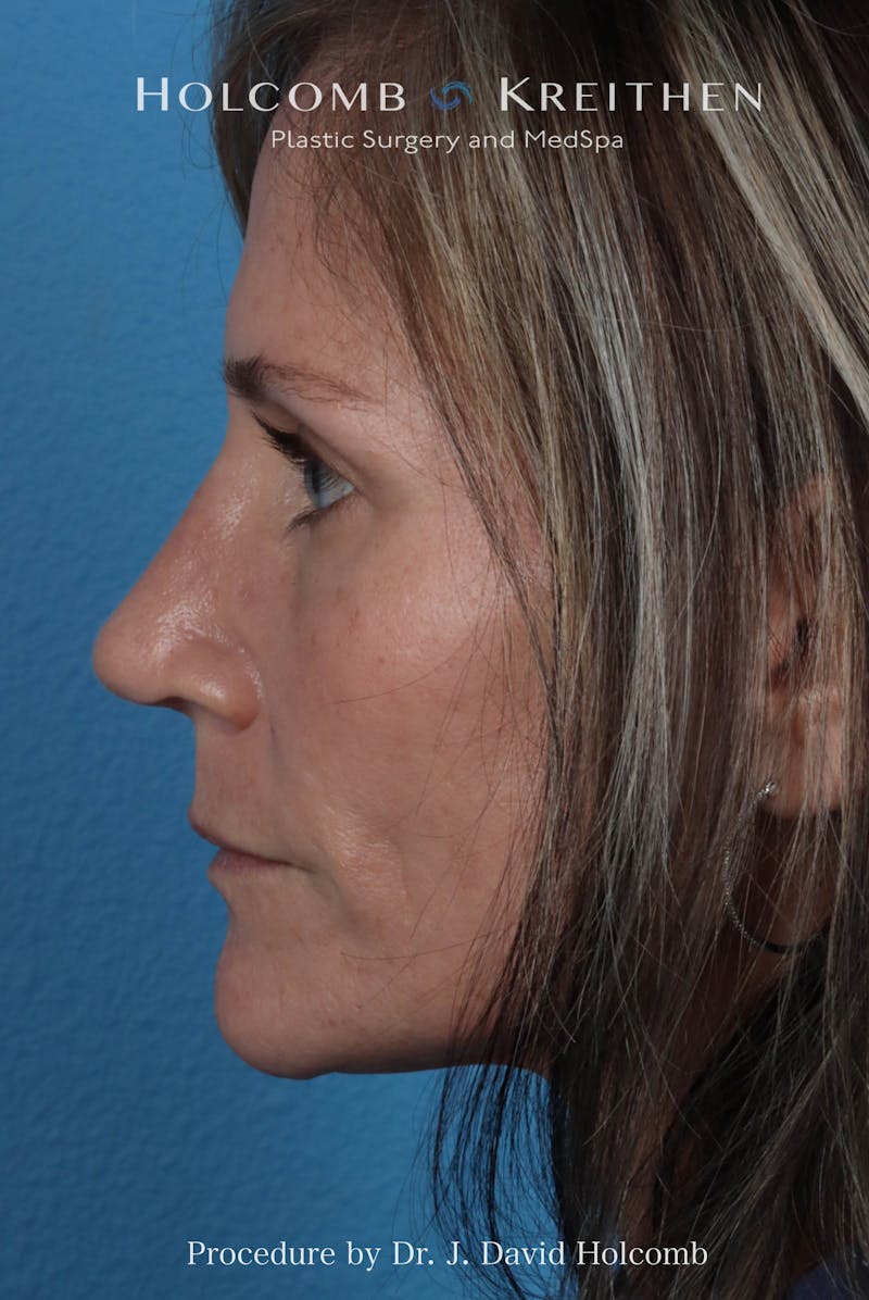 Rhinoplasty Before & After Gallery - Patient 104927 - Image 2