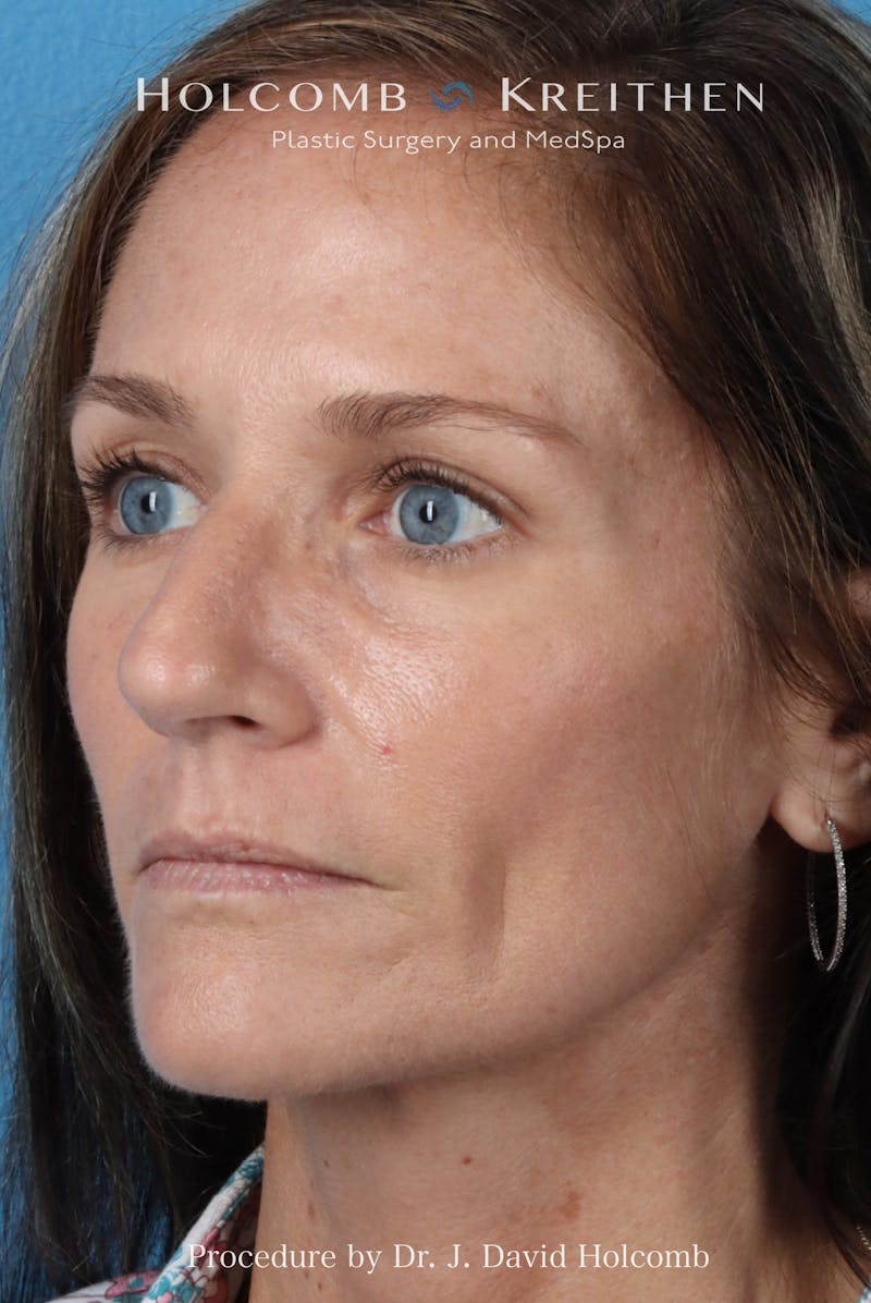 Rhinoplasty Before & After Gallery - Patient 104927 - Image 7