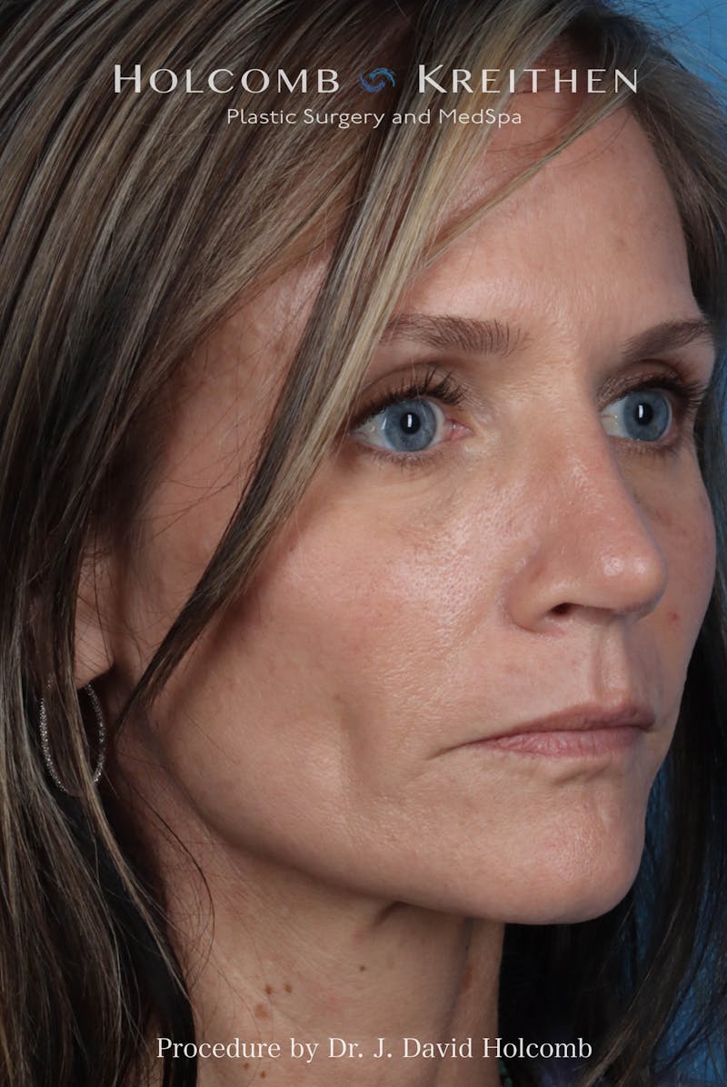 Rhinoplasty Before & After Gallery - Patient 104927 - Image 6
