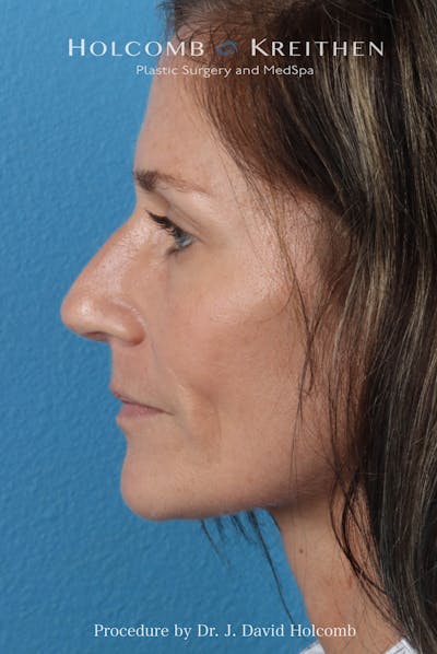 Rhinoplasty Before & After Gallery - Patient 104927 - Image 1