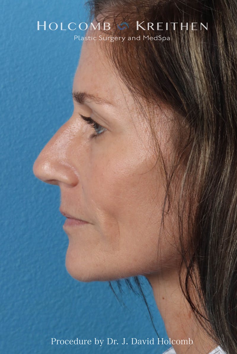 Rhinoplasty Before & After Gallery - Patient 104927 - Image 1