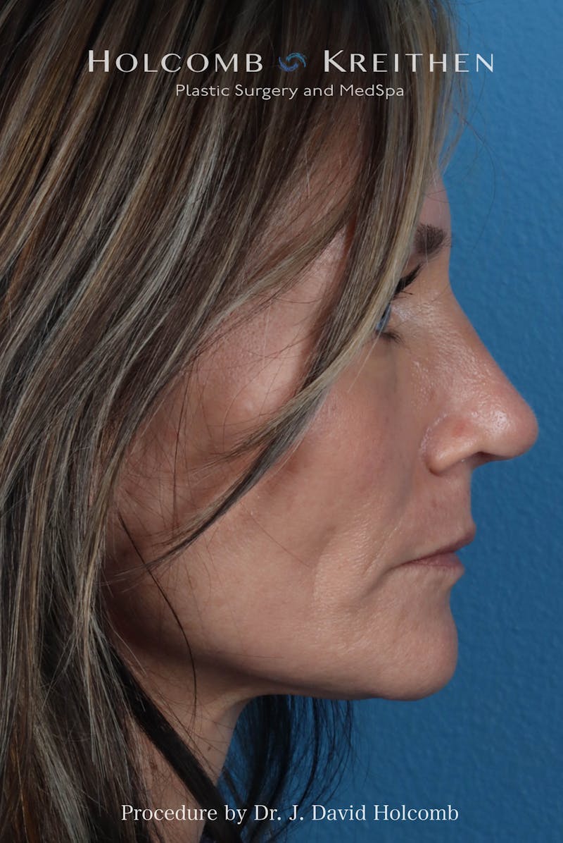 Rhinoplasty Before & After Gallery - Patient 104927 - Image 10