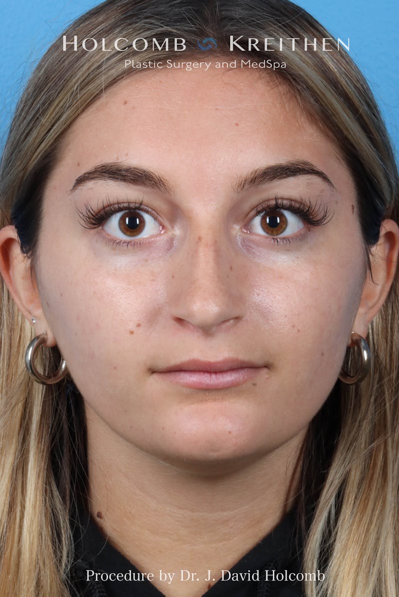 Rhinoplasty Before & After Gallery - Patient 259560 - Image 3