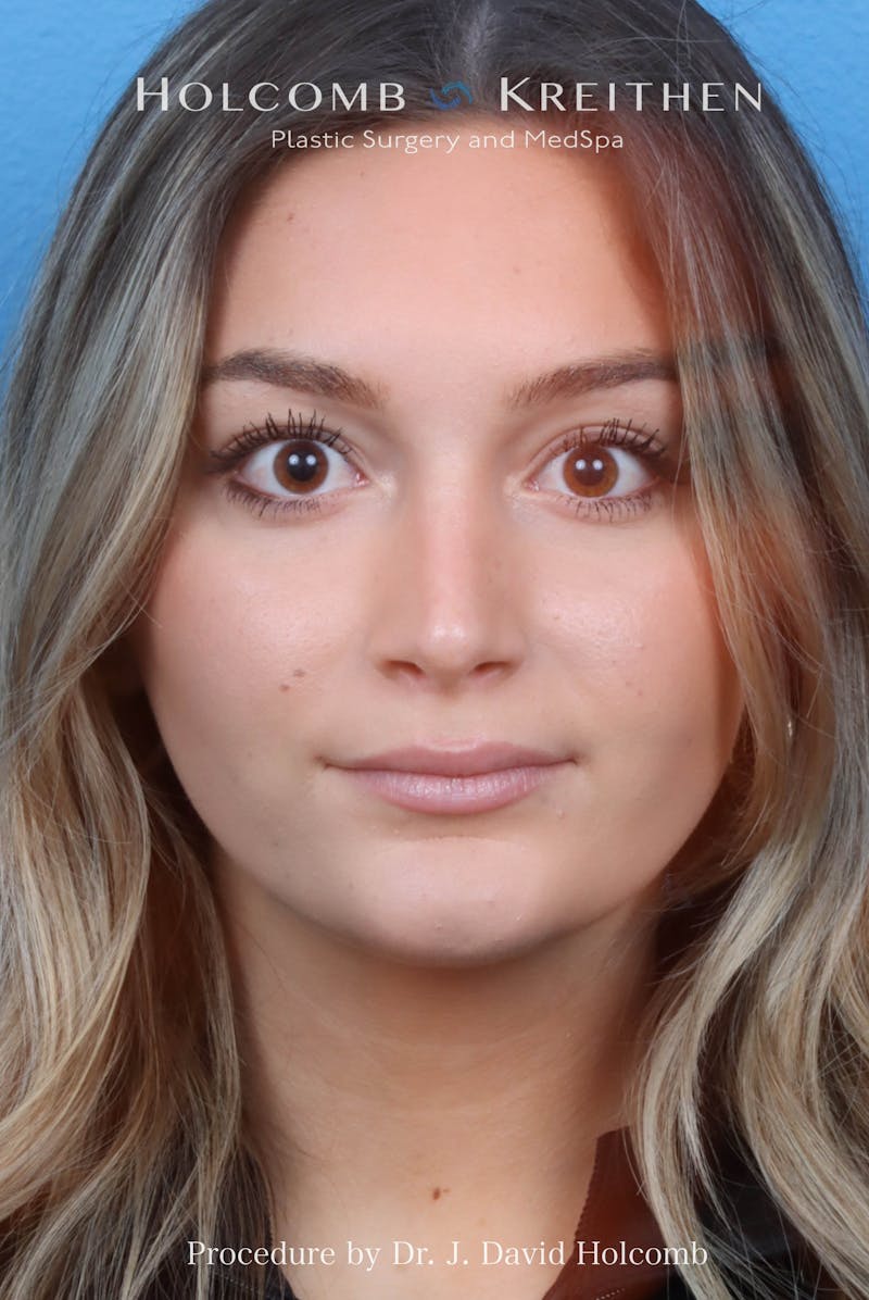 Rhinoplasty Before & After Gallery - Patient 259560 - Image 4
