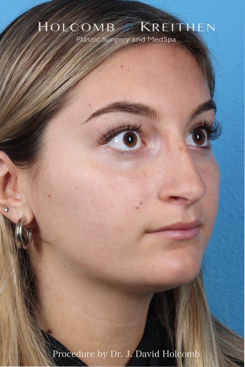 Rhinoplasty Before & After Gallery - Patient 259560 - Image 5