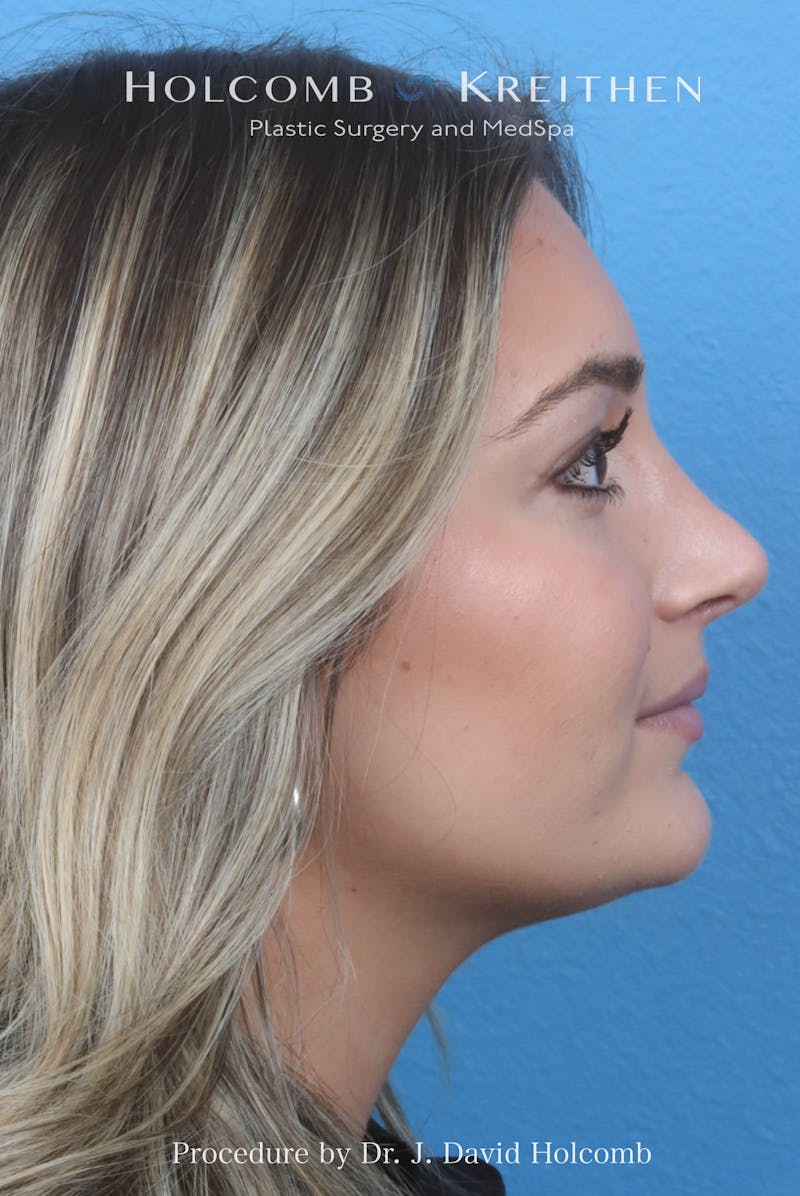 Rhinoplasty Before & After Gallery - Patient 259560 - Image 2
