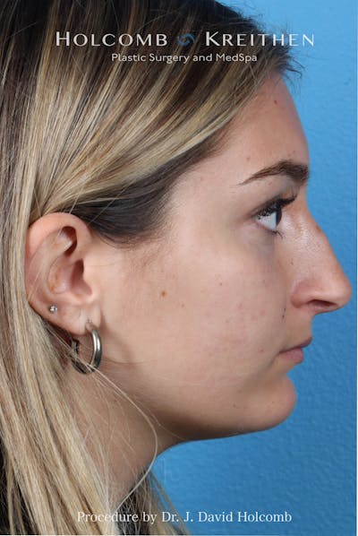 Rhinoplasty Before & After Gallery - Patient 259560 - Image 1