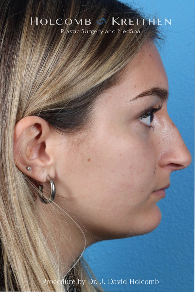 Rhinoplasty Before & After Gallery - Patient 259560 - Image 1
