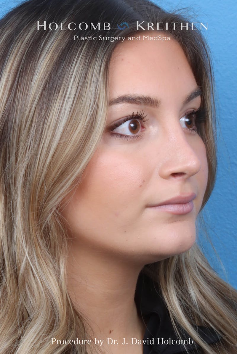Rhinoplasty Before & After Gallery - Patient 259560 - Image 6