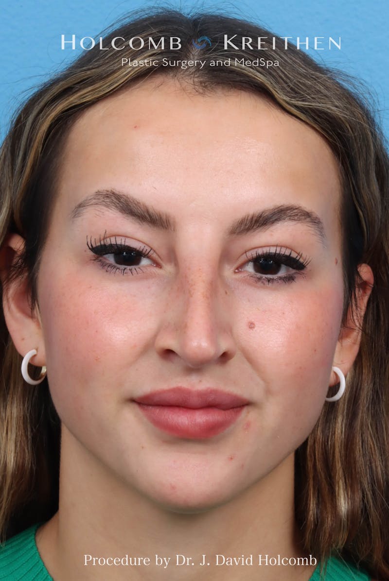 Rhinoplasty Before & After Gallery - Patient 197636 - Image 3