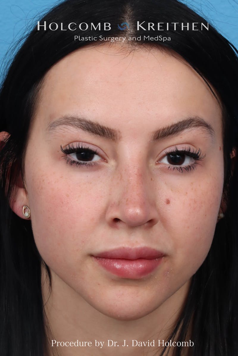 Rhinoplasty Before & After Gallery - Patient 197636 - Image 4