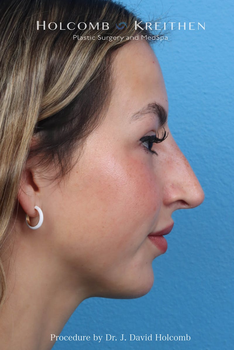 Rhinoplasty Before & After Gallery - Patient 197636 - Image 5