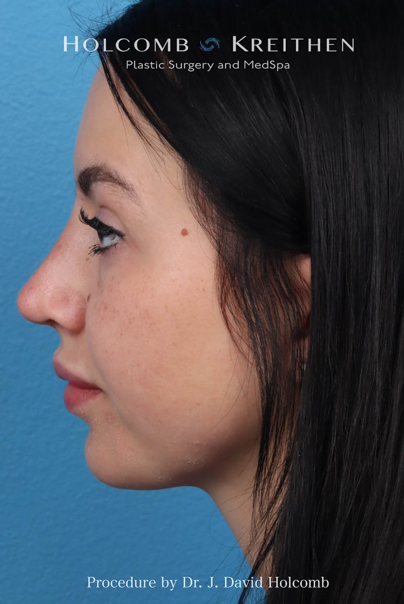Rhinoplasty Before & After Gallery - Patient 197636 - Image 2