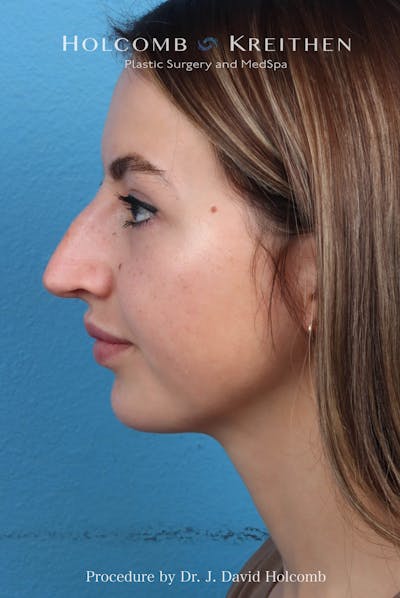 Rhinoplasty Before & After Gallery - Patient 197636 - Image 1