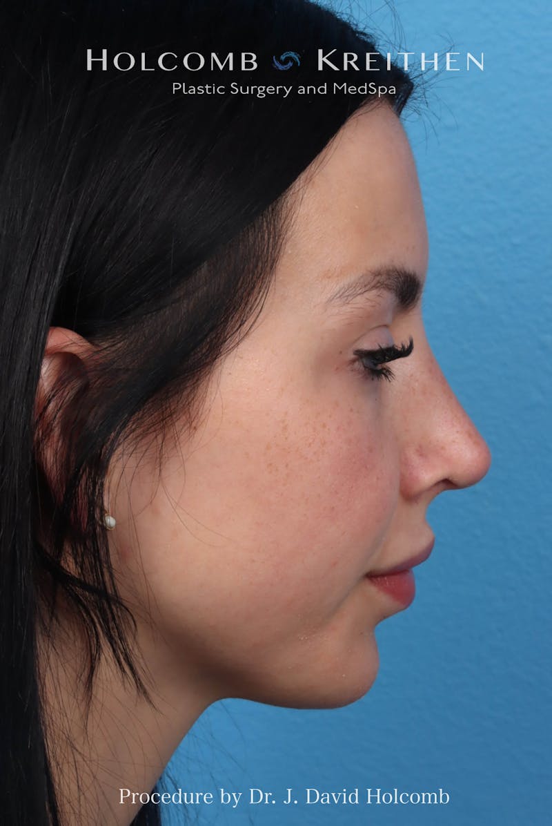 Rhinoplasty Before & After Gallery - Patient 197636 - Image 6