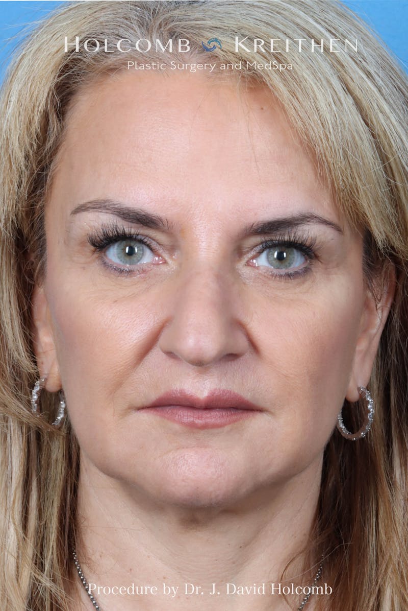 Rhinoplasty Before & After Gallery - Patient 485439 - Image 3