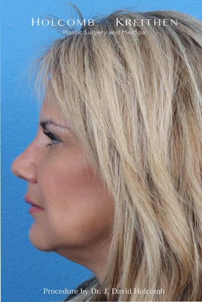 Rhinoplasty Before & After Gallery - Patient 485439 - Image 2