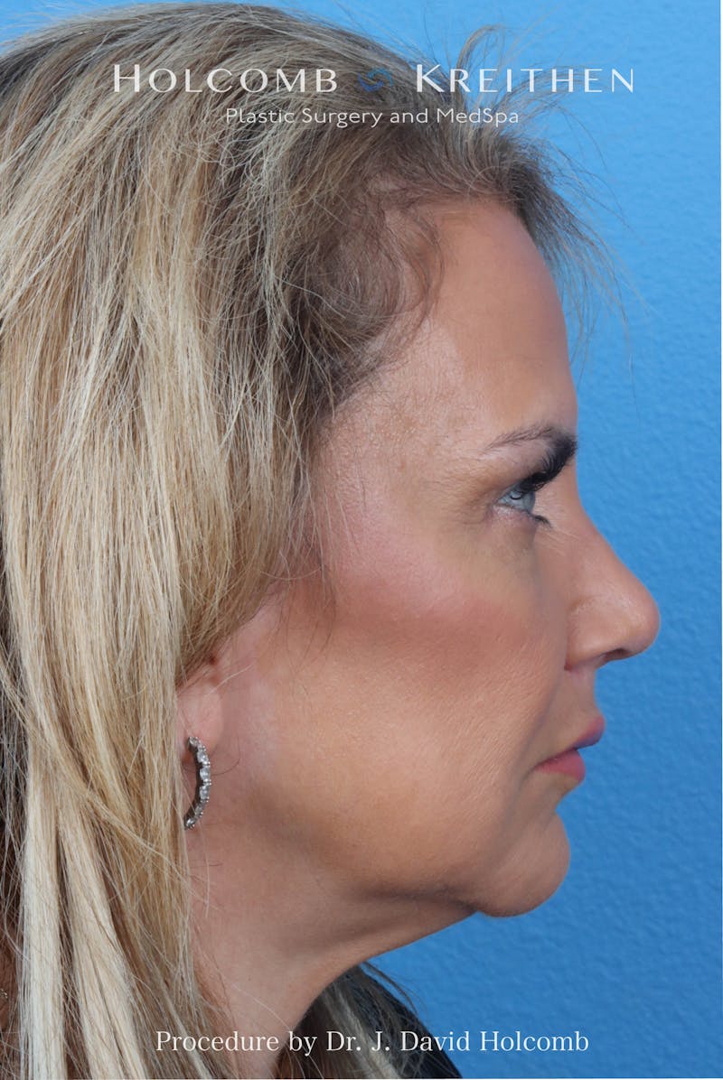 Rhinoplasty Before & After Gallery - Patient 485439 - Image 10