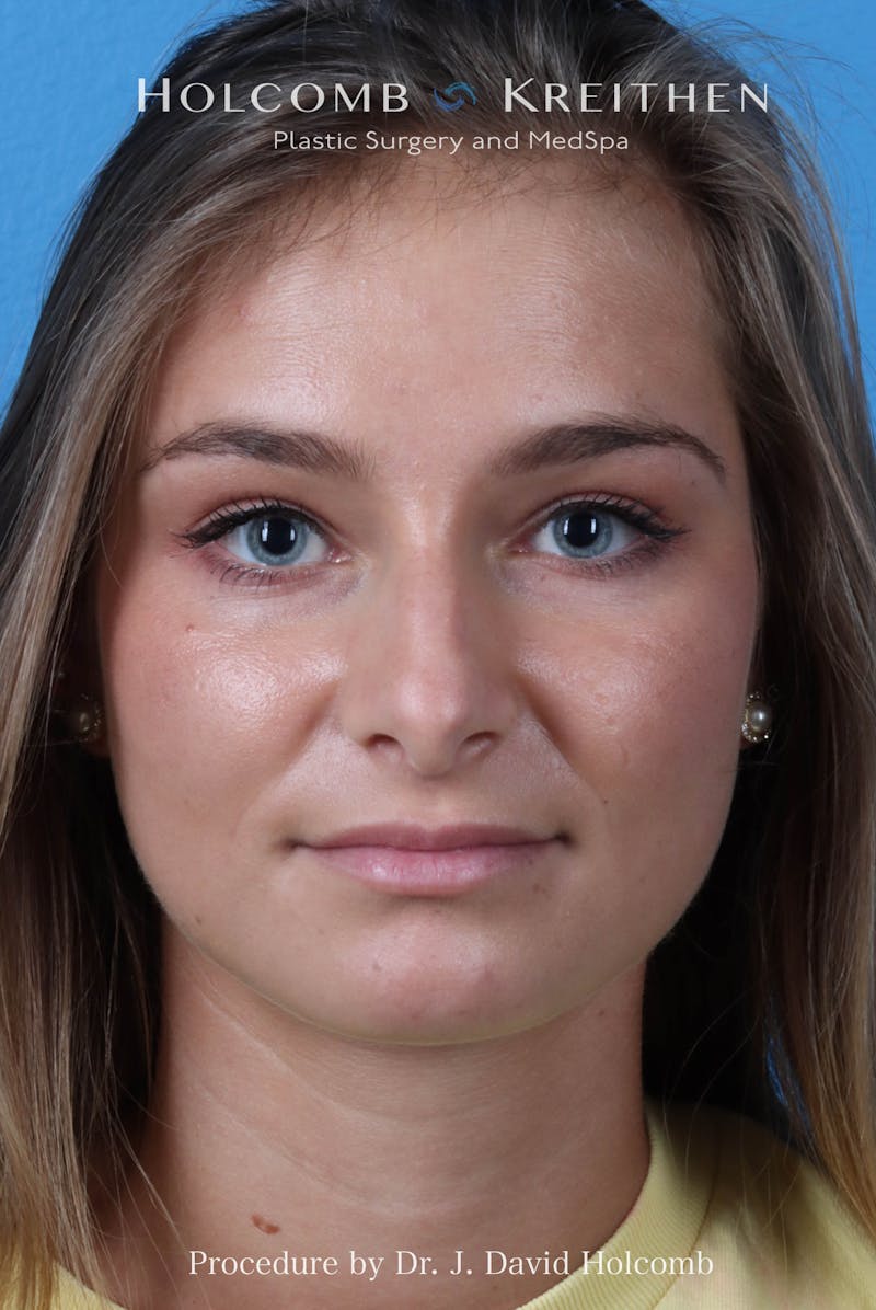 Rhinoplasty Before & After Gallery - Patient 198771 - Image 3