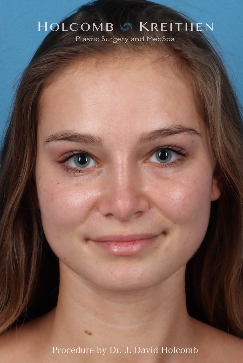 Rhinoplasty Before & After Gallery - Patient 198771 - Image 4