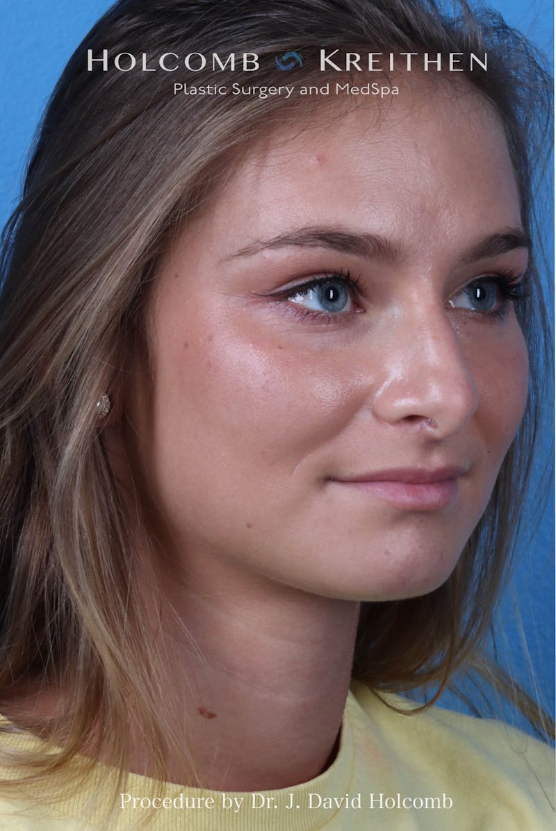 Rhinoplasty Before & After Gallery - Patient 198771 - Image 5