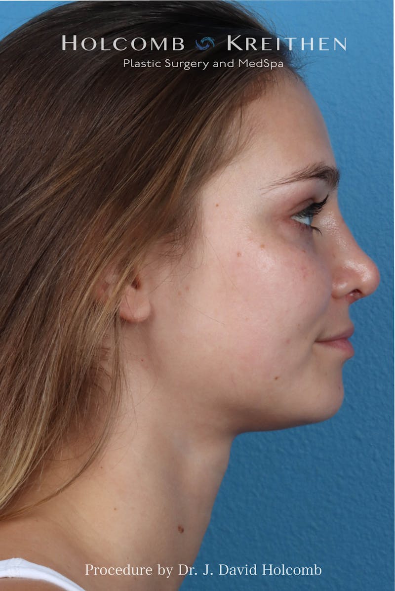 Rhinoplasty Before & After Gallery - Patient 198771 - Image 1