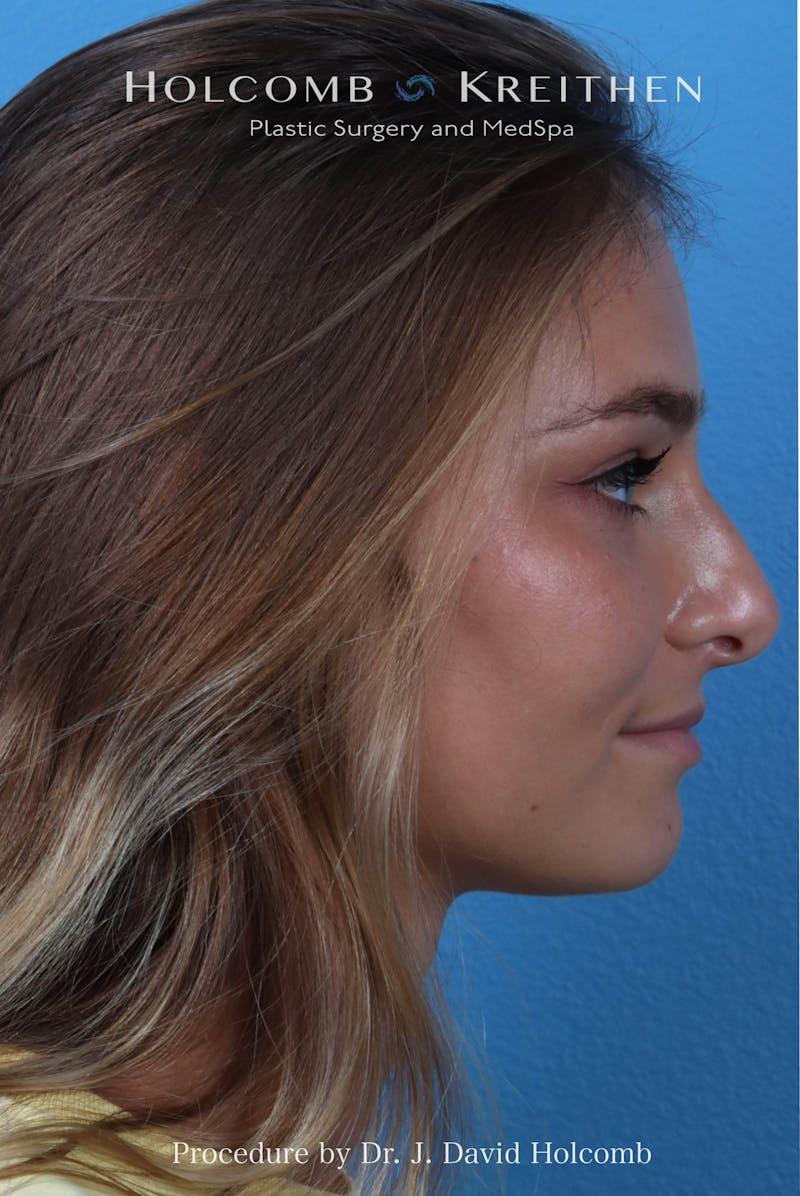 Rhinoplasty Before & After Gallery - Patient 198771 - Image 2