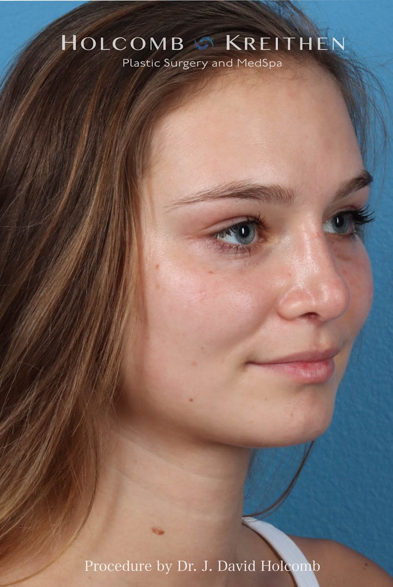 Rhinoplasty Before & After Gallery - Patient 198771 - Image 6