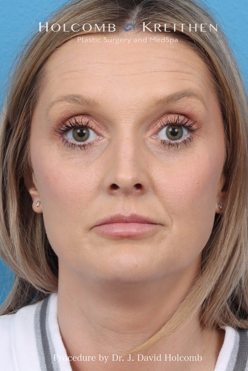 Rhinoplasty Before & After Gallery - Patient 382430 - Image 3