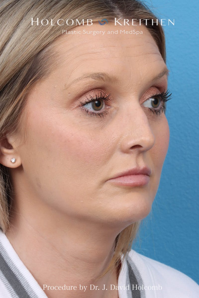 Rhinoplasty Before & After Gallery - Patient 382430 - Image 5