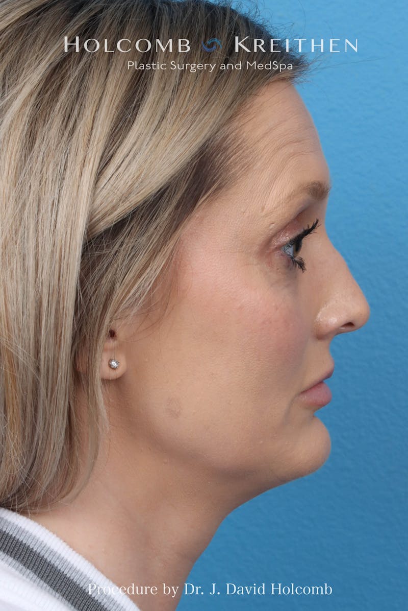 Rhinoplasty Before & After Gallery - Patient 382430 - Image 7