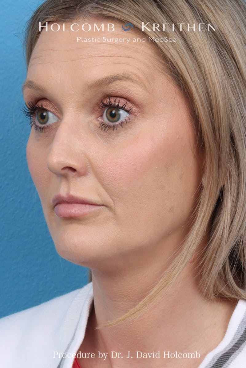 Rhinoplasty Before & After Gallery - Patient 382430 - Image 9