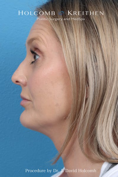 Rhinoplasty Before & After Gallery - Patient 382430 - Image 1