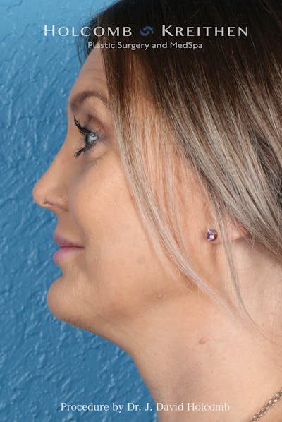 Rhinoplasty Before & After Gallery - Patient 382430 - Image 2