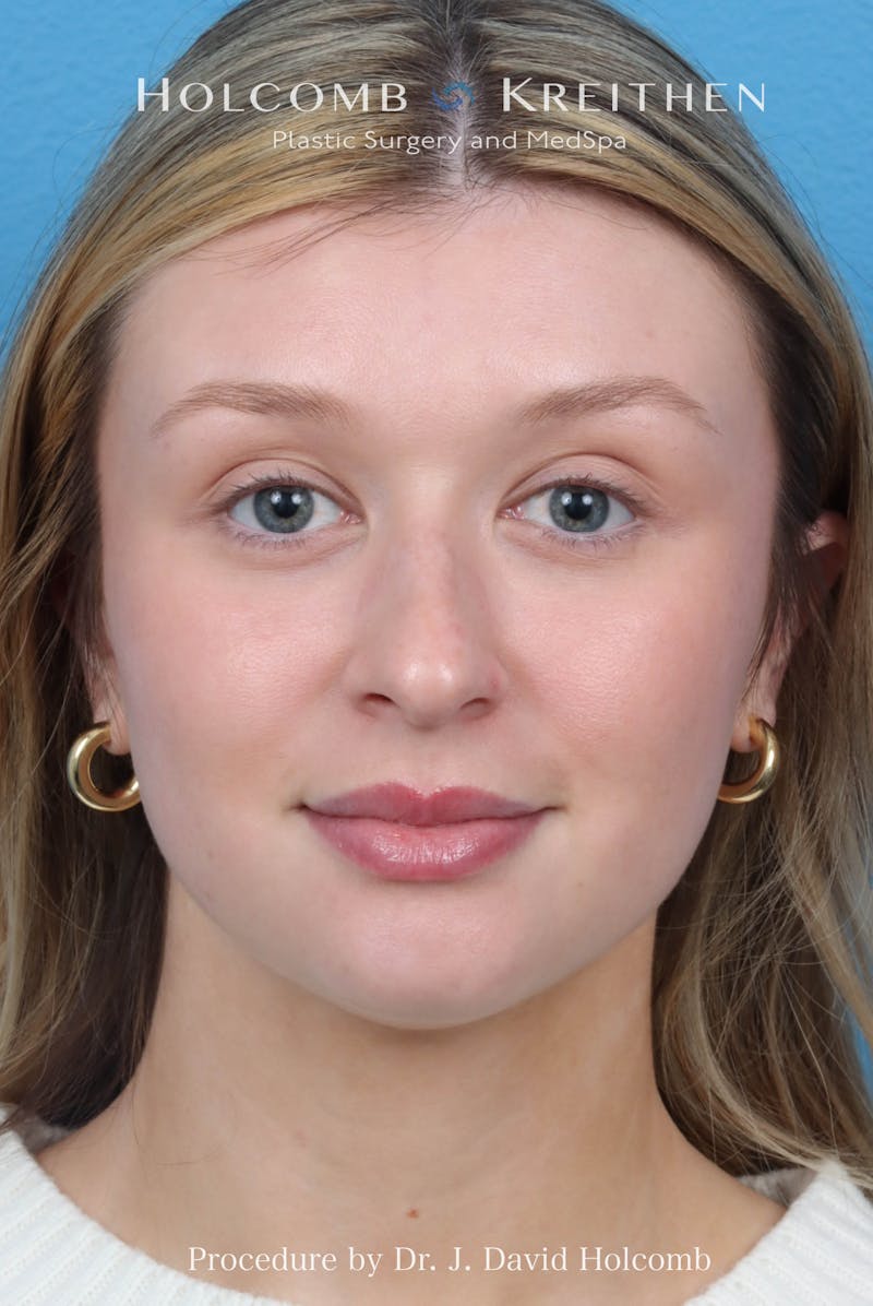 Rhinoplasty Before & After Gallery - Patient 303862 - Image 3