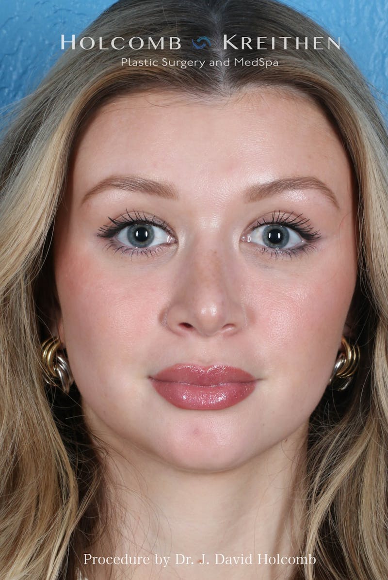 Rhinoplasty Before & After Gallery - Patient 303862 - Image 4