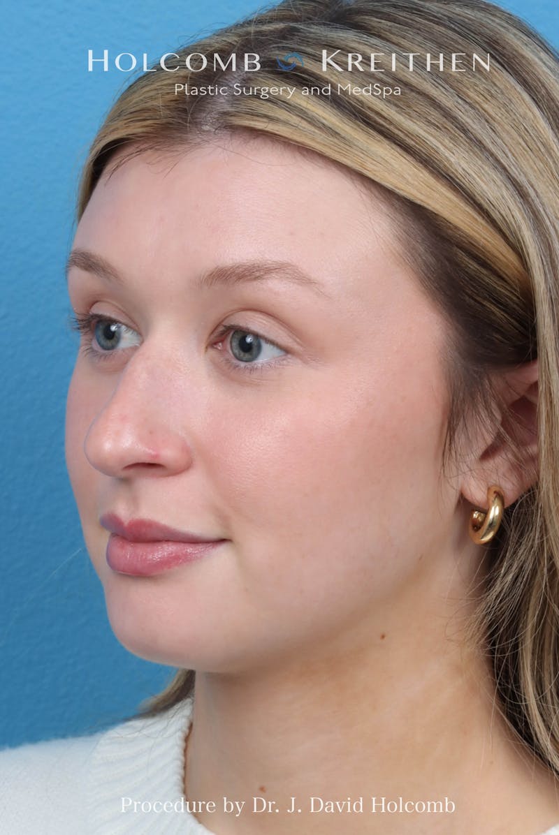 Rhinoplasty Before & After Gallery - Patient 303862 - Image 5