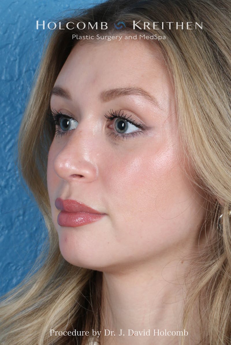 Rhinoplasty Before & After Gallery - Patient 303862 - Image 6