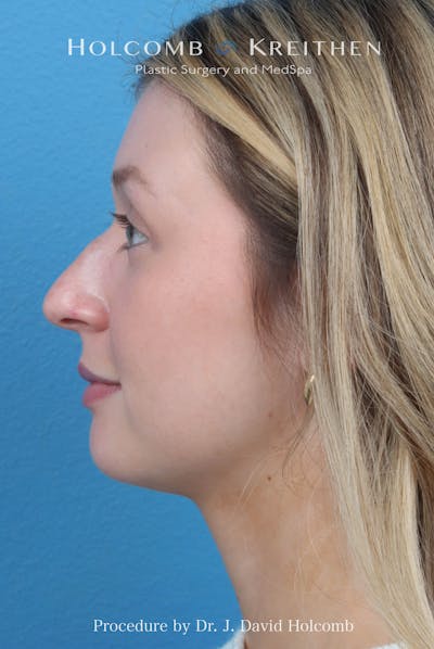 Rhinoplasty Before & After Gallery - Patient 303862 - Image 1