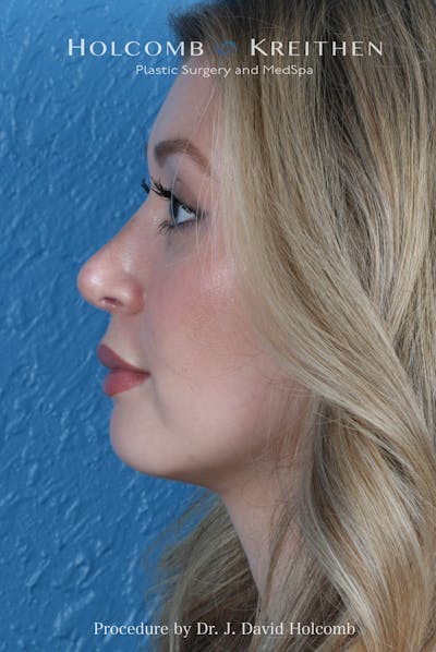 Rhinoplasty Before & After Gallery - Patient 303862 - Image 2