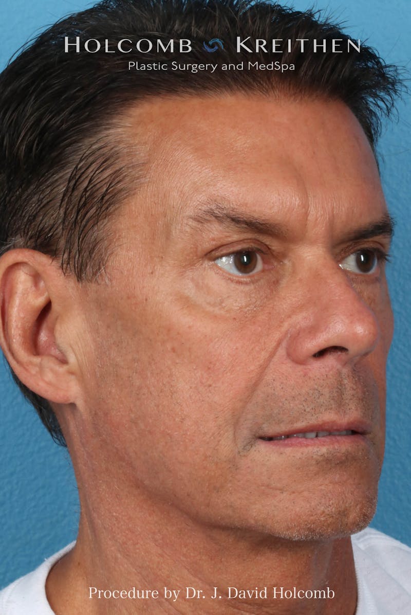 Rhinoplasty Before & After Gallery - Patient 336610 - Image 5