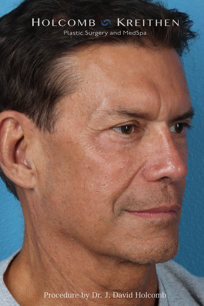 Rhinoplasty Before & After Gallery - Patient 336610 - Image 6