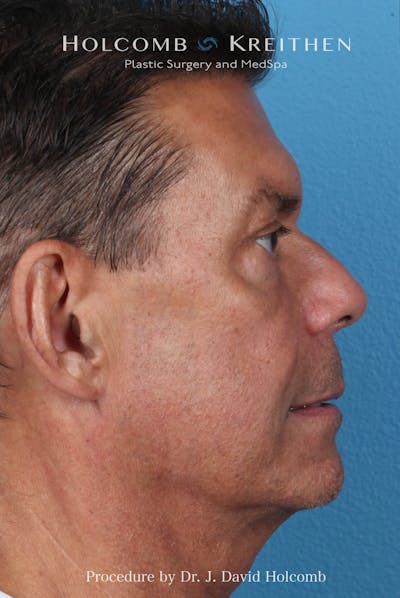Rhinoplasty Before & After Gallery - Patient 336610 - Image 1