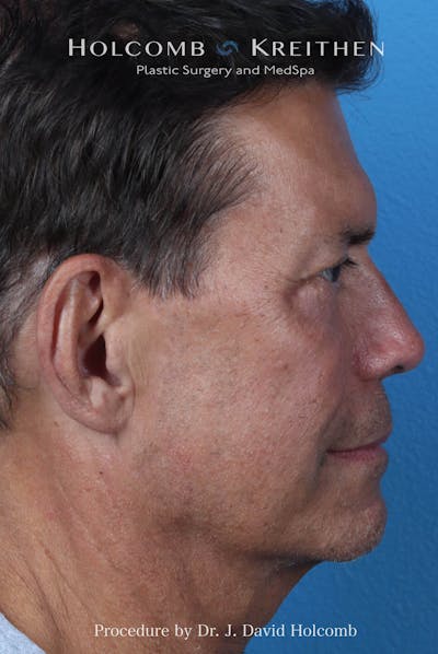 Rhinoplasty Before & After Gallery - Patient 336610 - Image 2
