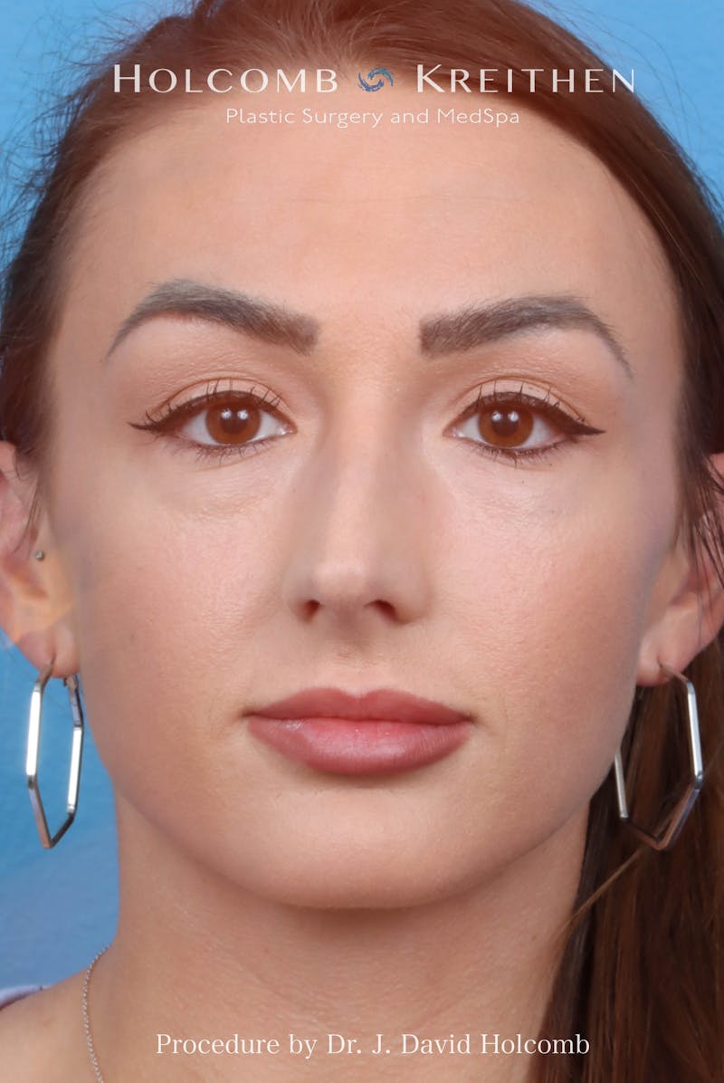 Rhinoplasty Before & After Gallery - Patient 417119 - Image 3