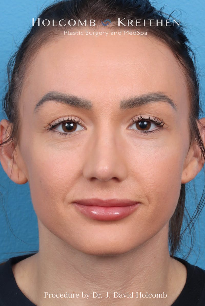 Rhinoplasty Before & After Gallery - Patient 417119 - Image 4